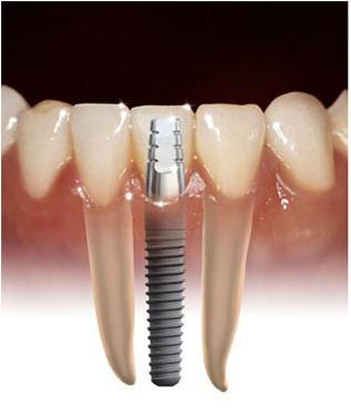 implantes dentales